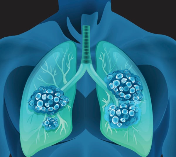 Air pollution reduces lung growth in children